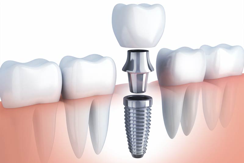 Implants Dentist in La Grange