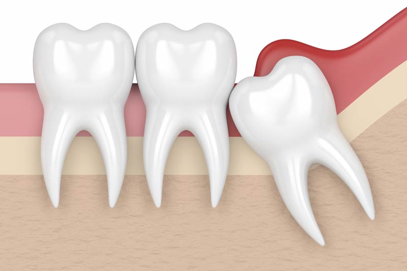 Wisdom Tooth Removal in La Grange